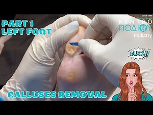 Calluses Removal|Αφαίρεση Κάλων 1 #callus #κεντροποδιου #footcare #podologos #podiatrist #podiatry