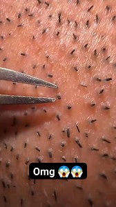 19K views · 484 reactions | 藍 #trypophobia #ticks #lice | Fitri Puspitasari | Facebook