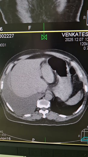 CT Thorax. Gross right sided pleural effusion. Complete collapse and consolidation of right lung.