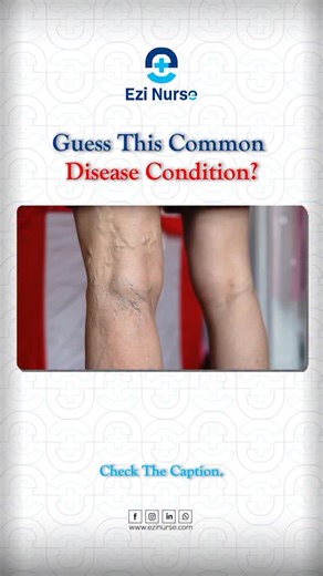 EZI Nurse | Best Online Learning App for Nursing Students | Comment your Answers. . . Read the caption . . 🩸 What Are Varicose Veins? Varicose veins are swollen, twisted, and enlarged veins, usually... | Instagram