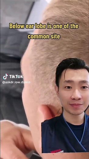 Cyst Removal: Home Treatment and Prevention Guide