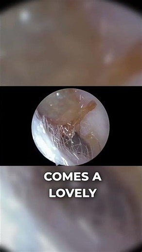 Perfectly Lubricated Earwax Plug Removed in One Piece | Wax Off Short Episode 83