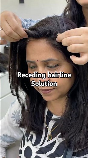 Receding Hairline to THIS 😍 | Hairline Topper Transformation| Best Solution for Frontal Thinning