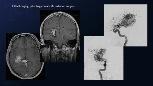 #417: Superior Parietal Lobule Approach for Resection of a Previously Radiated Posterior Thalamic Arteriovenous Malformation - Arteriovenous Malformation - Seven Series Collection