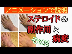 [Explanation in 6 minutes] Side effects of topical steroids and common lesions ②