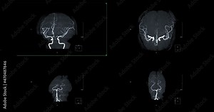 MRA Brain or Magnetic resonance angiography of Cerebral artery turn around on the screen. MRA Brain MIP view for evaluate cerebral artery.