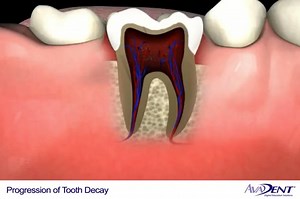 progression_of_tooth_decay.mp4_360