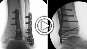 Posterolateral Approach to the Fibula and Tibia (Japanese Subtitles)