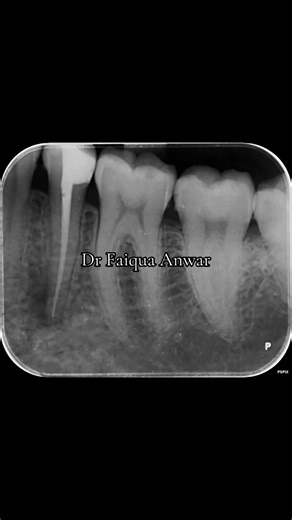 Case discussion!!! Fate of this tooth!!! #drfaiquaanwar #calculusslayer #dentist #fateofthetooth #pathology