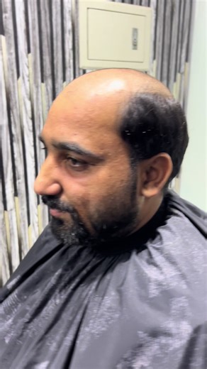 Hair Patching Transformation at Capital Hair Club