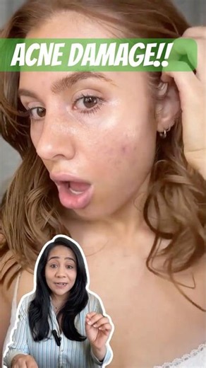 Stop Using Toothpaste on Pimples (Dermatologist Warning)