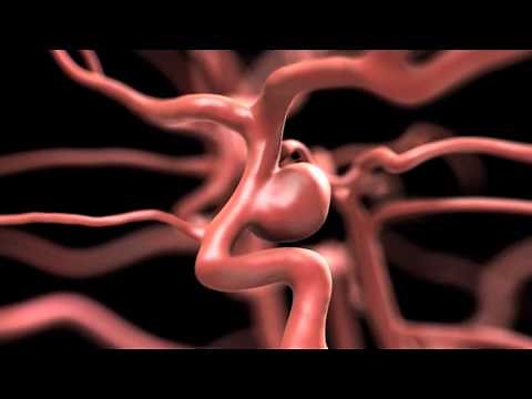 Using Pipeline® To Repair A Brain Aneurysm Without Surgery