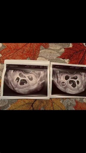 Pubity on Instagram: "🥰 After years of struggling with infertility, this family was surprised with quintuplets! 👶👶👶👶👶 The joy, the tears, and the laughter in their reactions say it all. A moment they, and everyone watching, will never forget. Hannah Merton via ViralHog #wholesome #pubity"