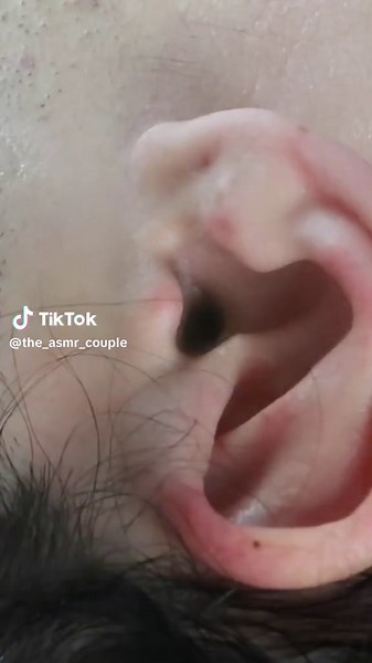Oddly satisfying ear STEAMING & PICKING #asmr #oddlysatisfying #fyp #foryou #foryoupage #explore #viral