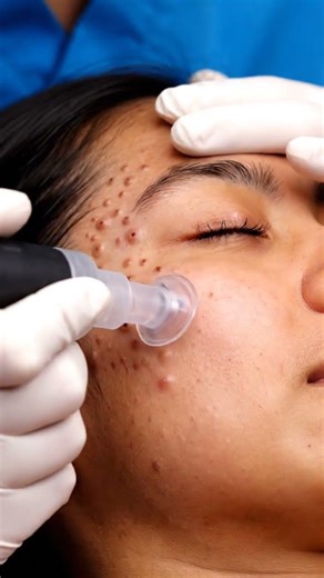 Satisfying ASMR Deep Cleanse: Blackhead Removal on Lower Chin Curve #asmr #shortvideo #satisfying