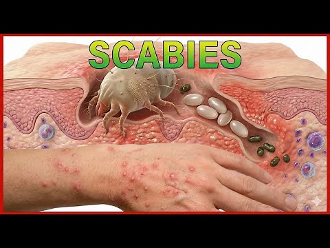 Scabies: Predisposing factors, Pathogenesis, Types, Clinical features, Diagnosis, Treatment