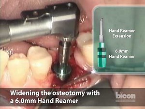 Placement of a Bicon SHORT® Implant and the Uncovering of Two Bicon SHORT® Implants