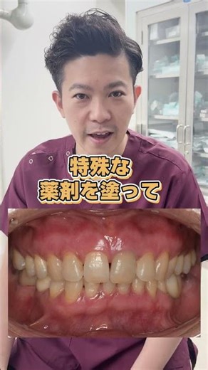 [Get back your smile] Get rid of darkened gums with gum peeling! [Dentist]