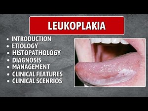 Best Lecture on Leukoplakia: Understanding and Managing White Lesions of the Oral Cavity