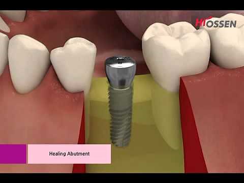 Hiossen-Osstem ETIII Implannt Placement with Taper Kit
