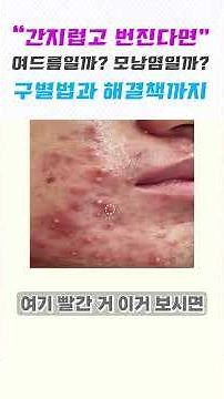 ✨간지럽고💥번진다면 여드름일까? 모낭염일까? 구별법과 해결책까지❗️ #모낭염 #모낭염관리 #모낭염없애는방법 #여드름 #에스로반