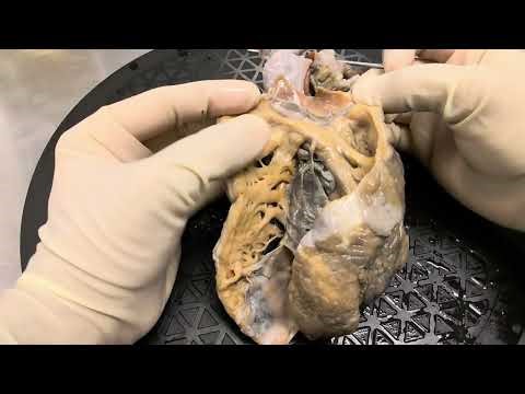 Specimen walkthrough 14- Ebstein malformation! Cardiac anatomy & pathology!