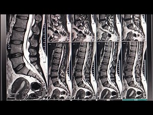 MRI LS spine with whole spine survey