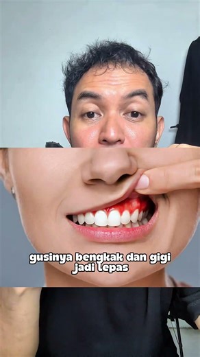 Cegah karang gigi