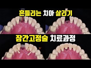 흔들리는 치아 살리기. 잠간고정술 고정 치료법