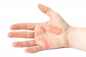 Rougeur qui évolue rapidement en cloques, Éruptions cutanées : les signes inquiétants