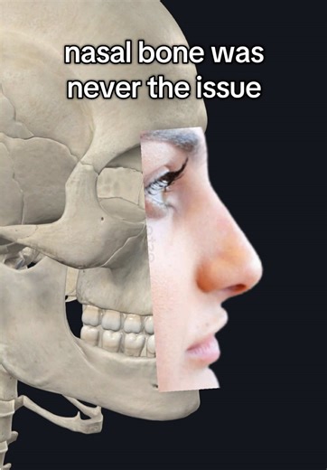 Retruded Nasal Spine: Understanding the Condition