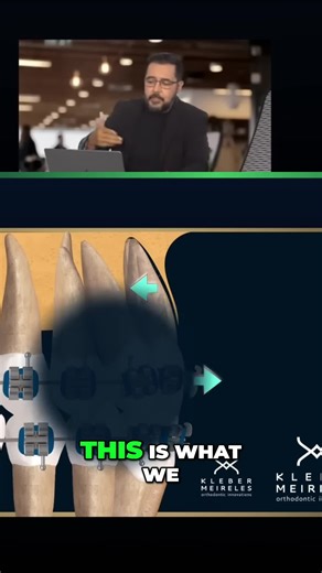 The 'rowboat effect' explained! See how torque can impact your teeth when straightening them. #Orthodontist #Braces #Invisalign #TikTokTaughtMe #Dentist