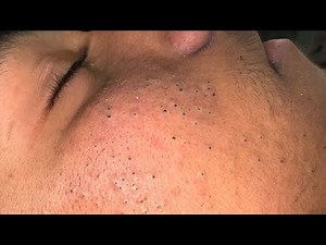 Deep Blackhead Removal & Pimple Treatment | Ultimate Facial Care Routine