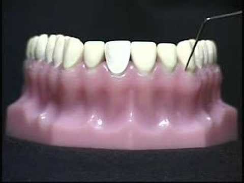 Laser Dental Cleaning