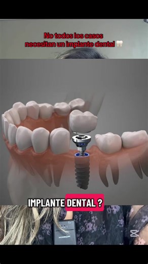 No todos los pacientes necesitan un implante dental. Existen alternativas como puentes u otras opciones según cada caso 🦷 Lo más importante es recuperar la masticación, la función y la estabilidad. La mejor opción siempre será la que esté indicada específicamente para ti. ✨ #fyppppppppppppppppppppppp #implantesdentales #odontologia #implantes