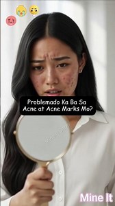 AZELANE Soap ACNE & MARKS Treatment. #acne #facialtreatment #facial #shorts