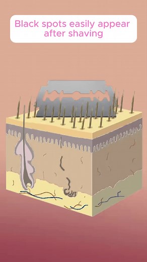 MLAY IPL Hair Removal Device Explained