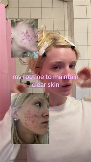Can’t believe those pics are 3 years old #acne #skincareroutine | Skincare Routines