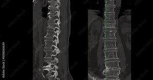 CT Scan L-S pine Showing T12 Compression Injury, where the front part of the bone has collapsed slightly. The fracture looks stable, and there is no damage to the spinal cord or nearby tissues.