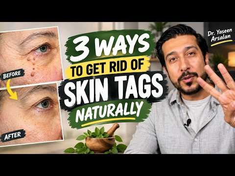 How to Remove Skin Tags at Home FAST 3 Simple Natural Remedies! DR YASEEN ARSALAN