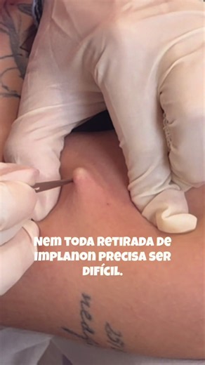 “Você acha que retirar um Implanon precisa ser um procedimento demorado ou traumático? Neste vídeo, a retirada foi realizada em poucos segundos. Isso não acontece por acaso. A diferença está no planejamento, na técnica e na experiência do profissional. Cada mulher merece um atendimento seguro, humanizado e individualizado, especialmente quando falamos de um procedimento tão importante. Se você precisa retirar seu Implanon, escolha um local onde sua segurança seja prioridade do início ao fim. ✨ N