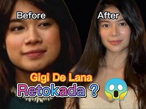 GIGI DE LANA | BEFORE AND AFTER SURGERY 😱