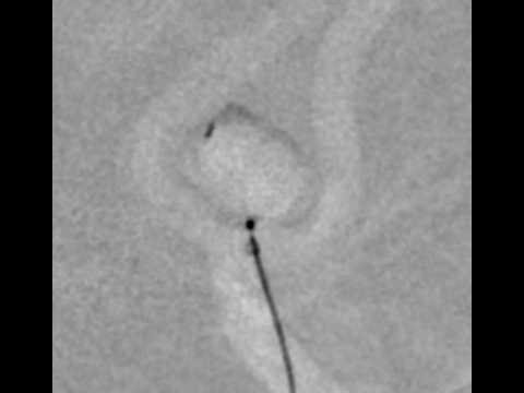 Intrasaccular Device (Artisse) in Acom Aneurysm