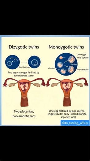 Nursing & Medical Profession 🔵 on Instagram: "Twins explained! 🤰➡️👶👶 Not all twins are the same! Here’s a simple breakdown: 🔹 Dizygotic (Fraternal) Twins · Two separate eggs fertilized by two separate sperm · Each has its own placenta and amniotic sac · Genetically like regular siblings 🔹 Monozygotic (Identical) Twins · One egg fertilized by one sperm, then splits early · May share a placenta (but usually have separate sacs) · Genetically identical Double the miracle, double the love! Whet