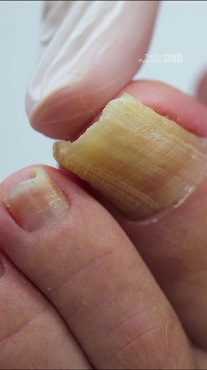 Doctor Treats Discolored Toenails & Fungal Infection | The Bad Foot Clinic