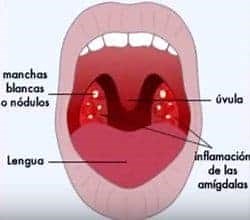 Amigdalitis o Anginas - ¿Qué son? causas, síntomas, tratamientos