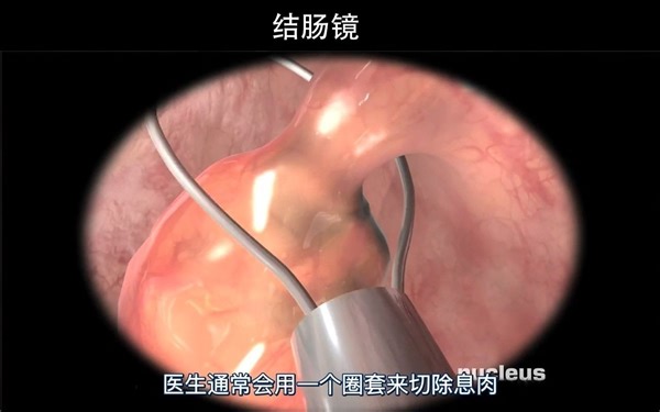 ColonScopy_1_压制版