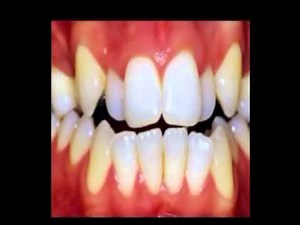 Lingual Braces Time Lapse