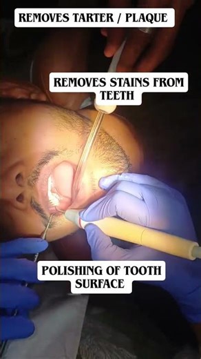 What really happens during Scaling Cleaning of teeth Scaling removes tarter, plaque and stains