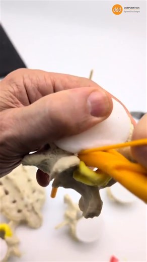 ✨ Behind the scenes of a unique build showing how the ligamentum flavum (LF) at the L4 5 segment can thicken and encroach on the L5 nerve root (L5 NR). No other spine model shows how the ligamentum flavum occupies space in the spinal canal and dynamically narrows the lateral recess just like in lumbar spinal stenosis.  Precision. Motion. Education. . . . #SpineModel #LumbarStenosis #MedicalEducation #DynamicDiscDesigns #SpinalHealth | Dynamic Disc Designs Spine Education Models | Facebook